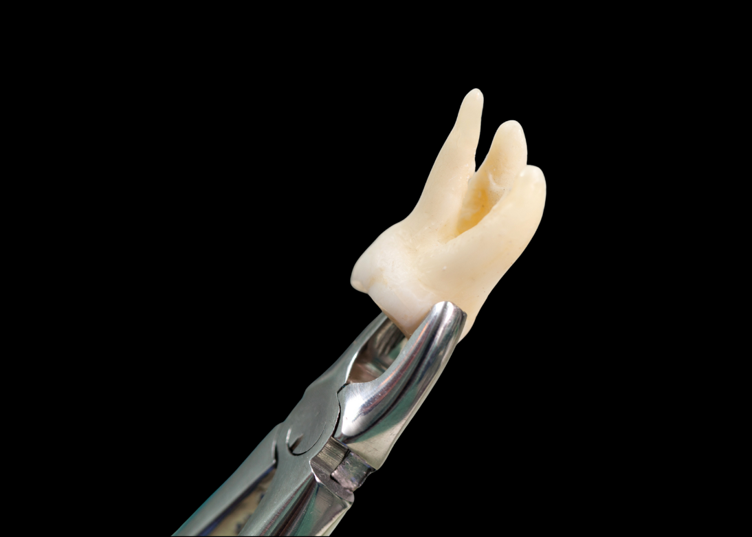 Extractions