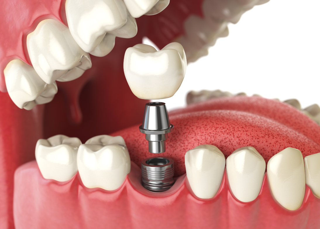 Bone Grafting